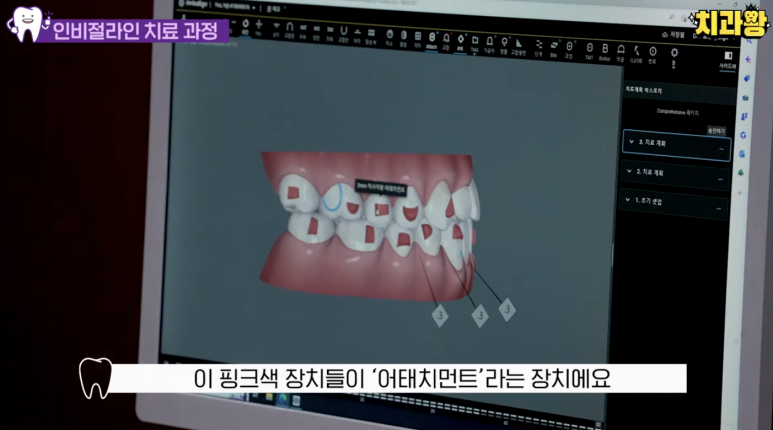 신사동 교정치과 인비절라인 가격 과정 알려드림 관련 이미지 13