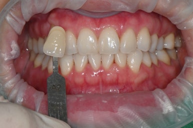 치아미백 시술 효과, 과정만큼 중요한 관리 방법 관련 이미지 4