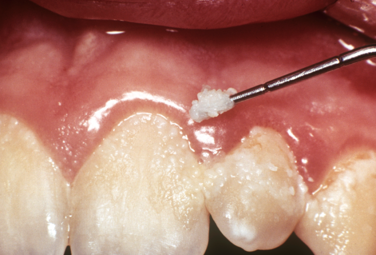 5 Causes of Tongue Coating: Cases That Can’t Be Solved by Brushing Alone image 3