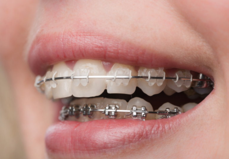 강남 돌출입 교정치과 분납 비용 부담된다면 관련 이미지 9