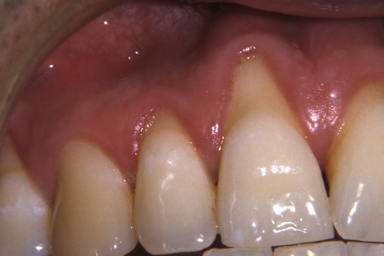 잇몸 부었을 때, 절대로 방치하면 안되는 증상 3가지 관련 이미지 9