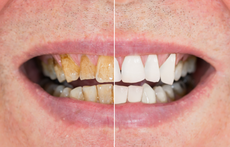 5 Causes of Yellow Teeth and DiscolorationㅣWhy Brushing Alone Doesn’t Work, Explained by a Dentist image 2