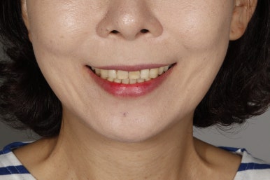 [블랑쉬치과] 치아 교정하고 난 후에 블랑쉬 가능할까요? 관련 이미지 4