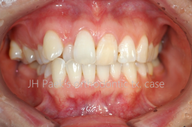 덧니 교정 비용? 관련 이미지 3