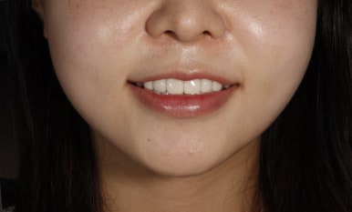 무삭제 라미네이트 비용, 이것만은 꼭 확인했어야 했어요 관련 이미지 5