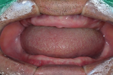 임플란트가 두렵다면 반드시 읽으세요! 관련 이미지 9