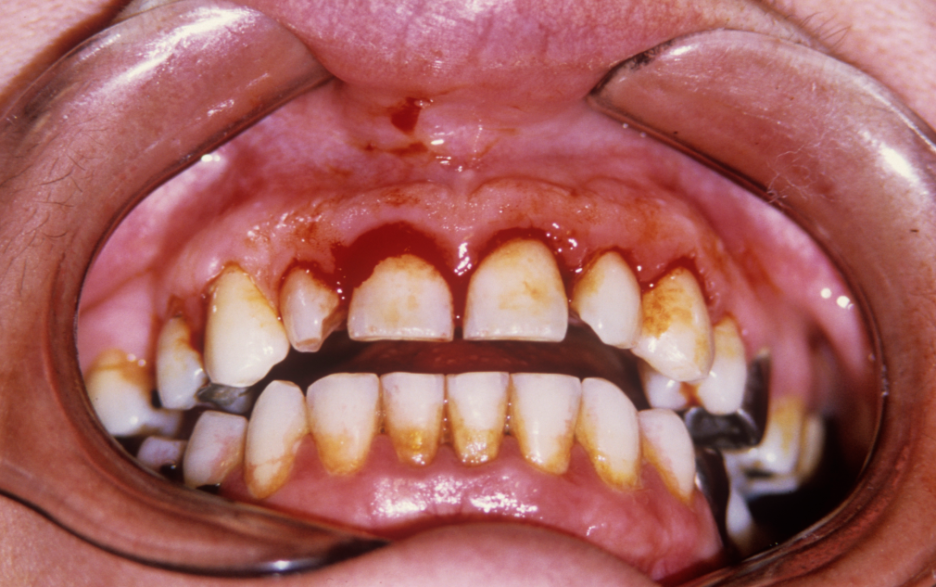 (피나는)잇몸 스케일링 방치하면 위험한 이유 관련 이미지 4