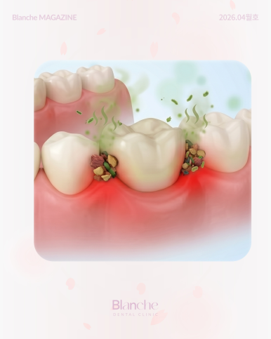 Bad Breath After Laminate Veneers: Is It Normal? Causes and Solutions image 10