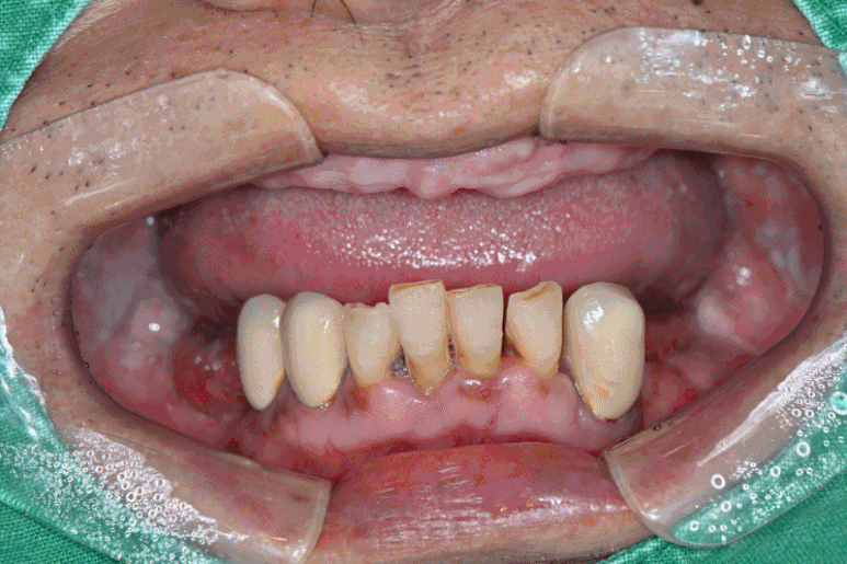 풀아치 임플란트 후기만 믿고 결정하기 전에 꼭 보세요 관련 이미지 6