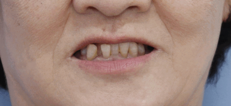 풀아치 임플란트 치과? 임플란트 결정 전 꼭 읽어보세요. 관련 이미지 1