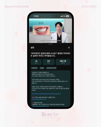 Bad Breath After Laminate Veneers: Is It Normal? Causes and Solutions image 16