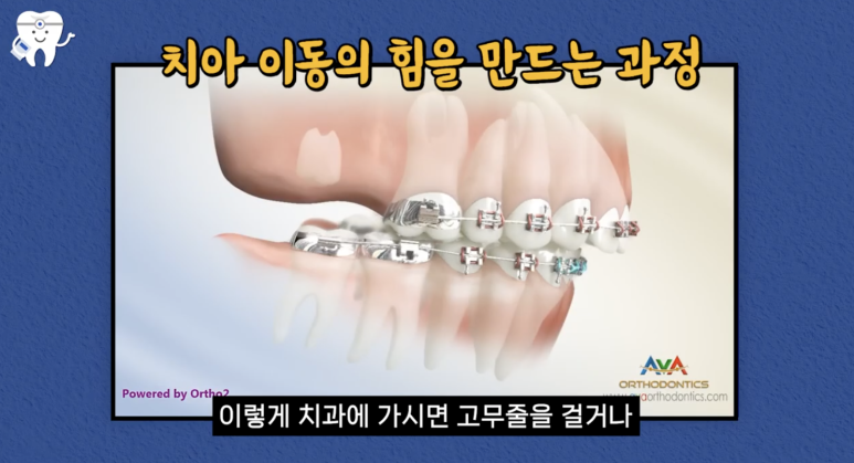 압구정치과 치아교정이 고민이라면 필독 관련 이미지 3