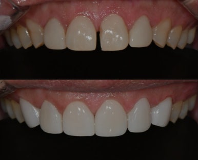 무삭제라미네이트 가격, 어떤 점을 알아보면 좋을까요? 관련 이미지 4