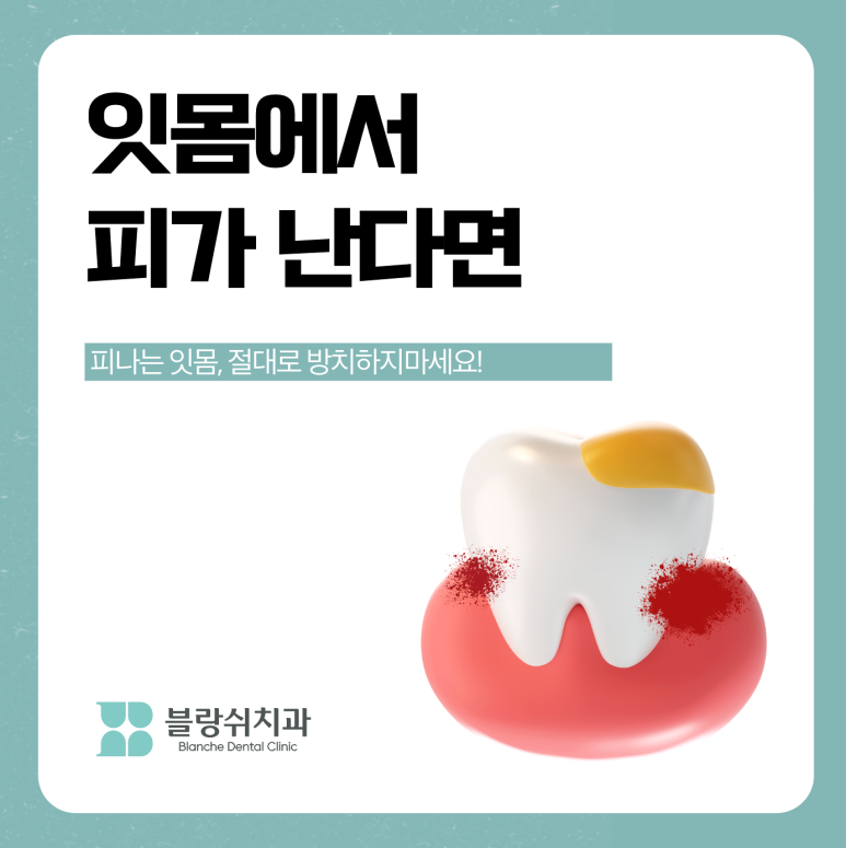 (피나는)잇몸 스케일링 방치하면 위험한 이유 관련 이미지 1