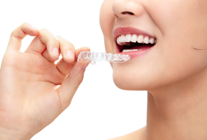 2 Factors Behind Differences in Orthodontic Costs: Something Else Matters More Than the Appliance image 4