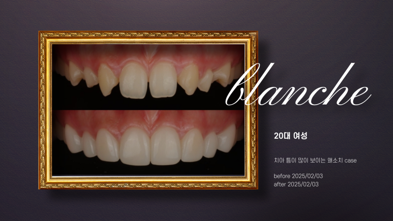 치아 고민별 블랑쉬 적합사례 총정리 관련 이미지 3