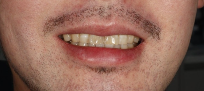 At-Home Teeth Whitening vs. Professional Dental Whitening: Which Should You Choose? image 3