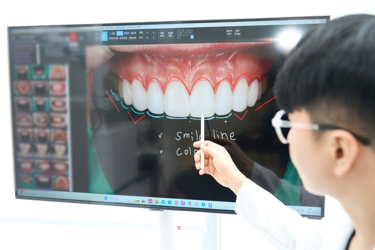 무삭제 라미네이트 부작용, 생각보다 다양했어요 관련 이미지 4