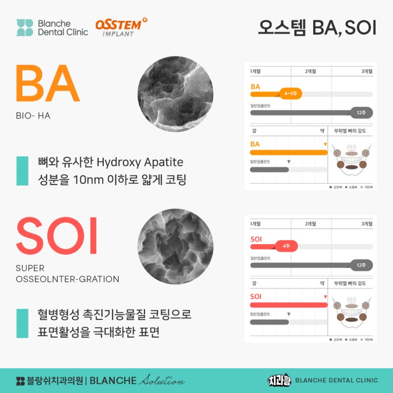 수면임플란트센터, 프리미엄 임플란트 진료는 블랑쉬치과(Blanche Dental Clinic) 관련 이미지 25