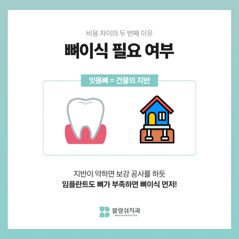 부분임플란트, 하나만 심으면 되는데 왜 비용 차이가 3배까지 날까? 관련 이미지 4