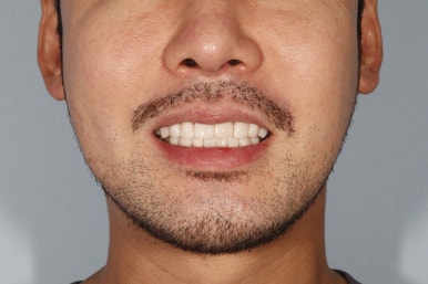 무삭제 라미네이트 부작용, 꼼꼼히 따져봐야할 핵심 관련 이미지 17