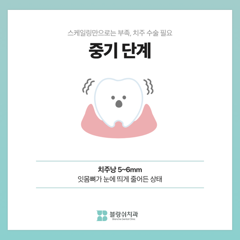 풍치 치료 초기&middot;중기&middot;말기, 단계별 치료비가 10배 차이 나는 이유 관련 이미지 7
