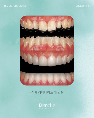 유독 작은 옆니(왜소치), 깎지 않고 예뻐질 수 있을까? 관련 이미지 6