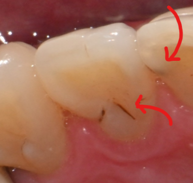 Cases Where Root Canal Treatment for Cavities Is Not Covered by National Health Insurance image 3