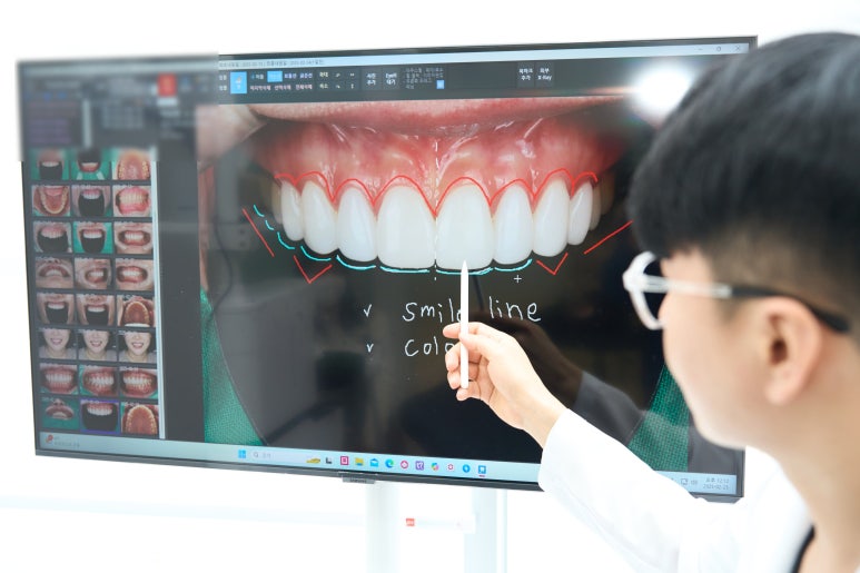 Check No-Prep Veneer Side Effects in Advance image 5