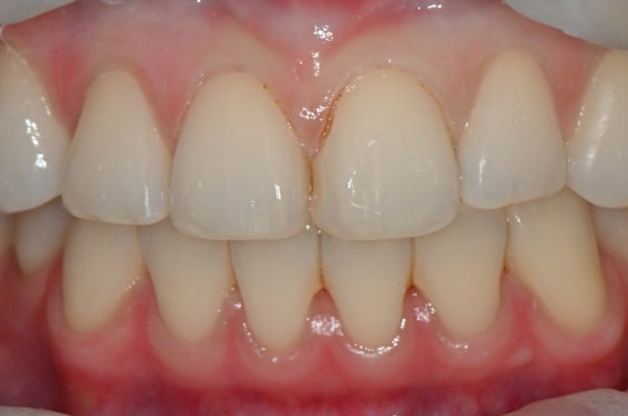 발치 없이 가능할까? 앞니 부분교정 전 반드시 체크해야 할 진단 포인트 관련 이미지 12