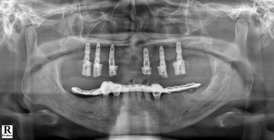 강남 풀아치 임플란트 치과, 4개로 틀니를 대체한다? 관련 이미지 8