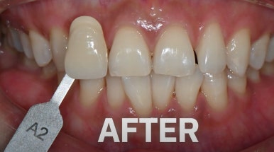 치아미백 시술,  시간과 가격 한계점까지 알려드립니다. 관련 이미지 12