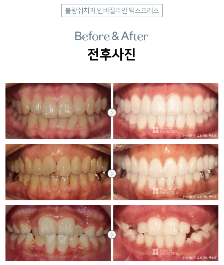 일반 투명교정 대신 인비절라인 하세요! 관련 이미지 5
