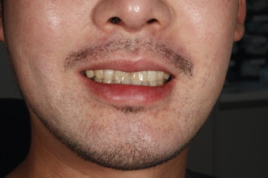 무삭제 라미네이트 부작용, 꼼꼼히 따져봐야할 핵심 관련 이미지 16