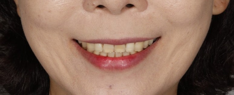 치아미백 시술? 블랑쉬? 어떤 것이 좋을지 고민된다면 관련 이미지 5