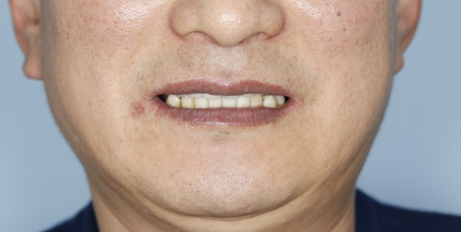 치주염 치료, 지금이랑 1년 뒤랑 뭐가 다를까요 관련 이미지 6