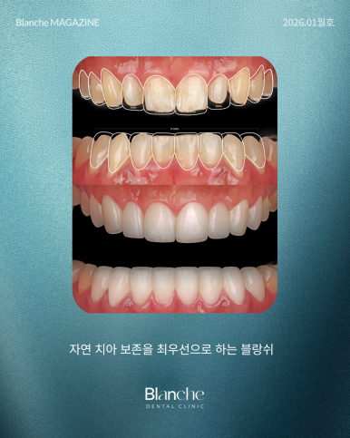 무삭제 라미네이트는 "부작용"이 없다? 관련 이미지 8