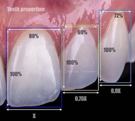 라미네이트 부작용 치아 삭제 전 반드시 알아야 할 것 관련 이미지 6