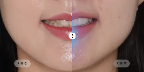 Can No-Prep Veneers Really Be Done at a Seocho Dental Clinic? Misconceptions and Facts image 4
