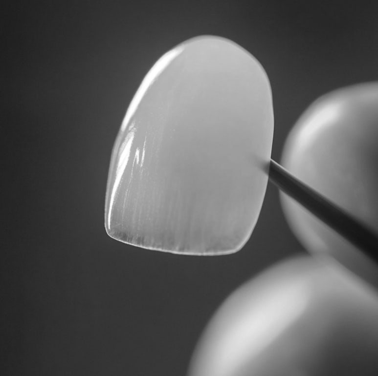 블랑쉬 라미네이트, 뭐가 다른지 궁금하셨다면? <의사 작성> 관련 이미지 12