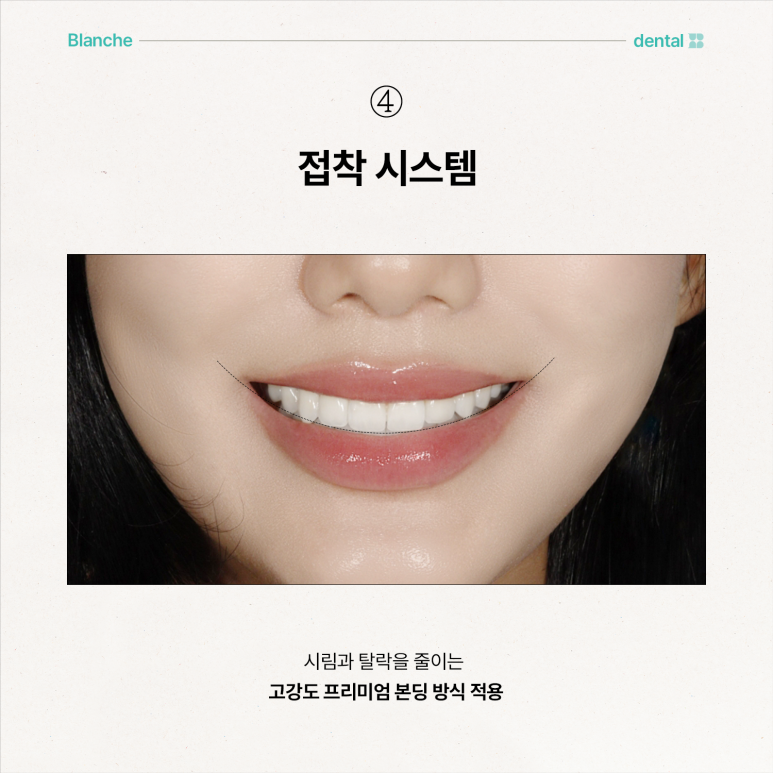 무삭제 라미네이트 부작용, 모르고 진행하면 손해보는 이유 관련 이미지 11