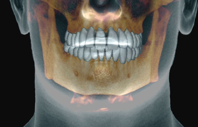 If You Hesitated Because Implant Bone Grafting Felt Frightening and Burdensome image 5