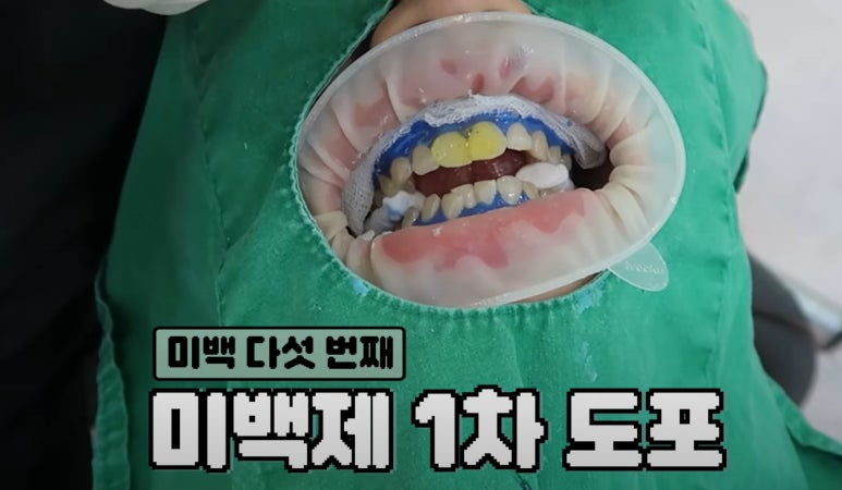 치아미백 시술,  시간과 가격 한계점까지 알려드립니다. 관련 이미지 7