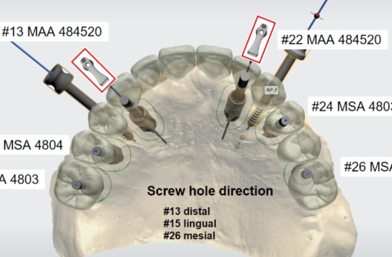 임플란트가 두렵다면 반드시 읽으세요! 관련 이미지 13