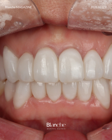 라미네이트 후 관련 이미지 5