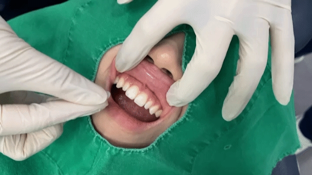 앞니 치료, 블랑쉬치과가 환자분들과 늘 함께 하겠습니다. 관련 이미지 2