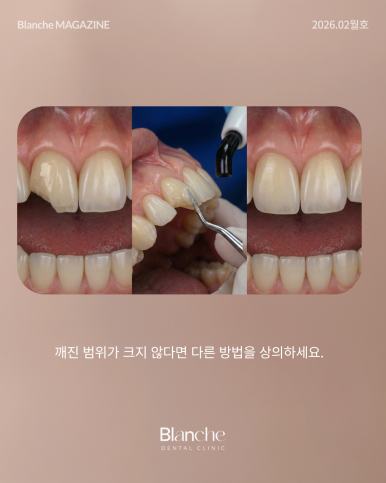 충치 치료, 무조건 깎아서 씌워야 할까? 관련 이미지 13