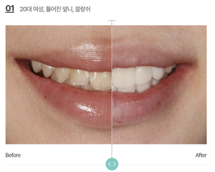 At-Home Teeth Whitening vs. Professional Dental Whitening: Which Should You Choose? image 6