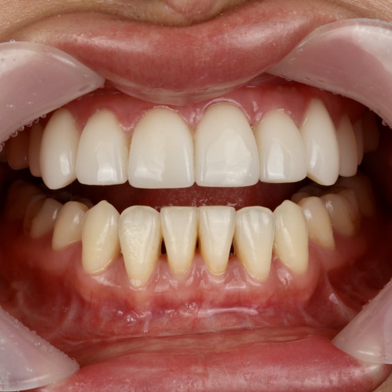 Black Triangles: Causes and Prevention to Know Before Resin Treatment image 3
