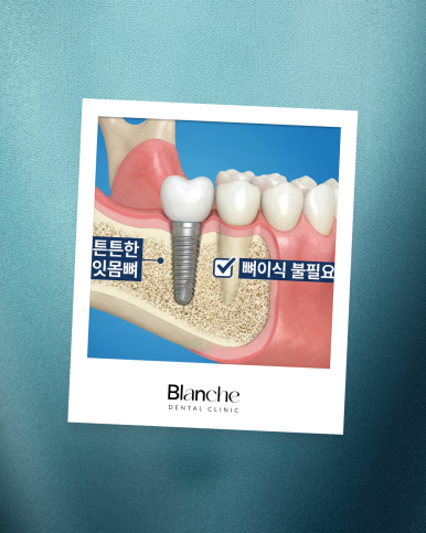"임플란트 뼈이식, 무조건 해야 하나요?" 과잉진료 피하는 법 관련 이미지 5